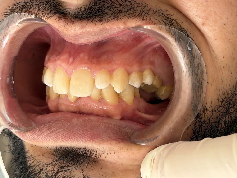 Avant : dents délabrées et désalignées, vue latérale