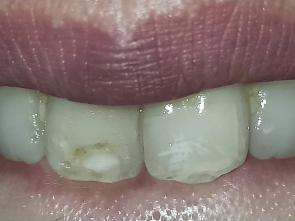 Avant : taches blanches marquées sur les incisives