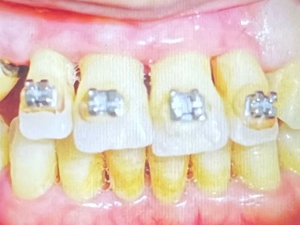 Avant : dents colorées sous appareil multibague